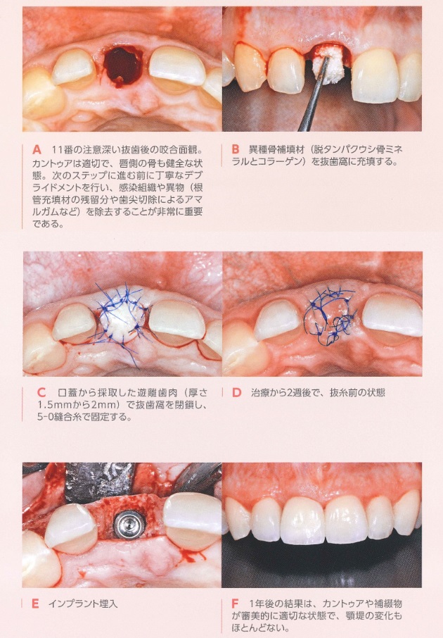 再生医療 GBR・CGF(テスト)—新越谷・南越谷のインプラントなら浅賀 ...