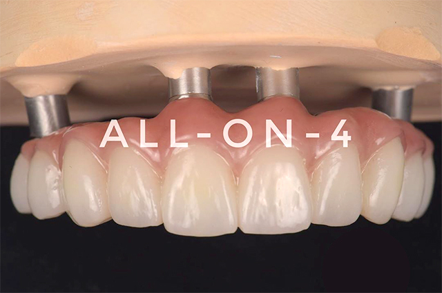 All-on-4(オールオン4)のメリット